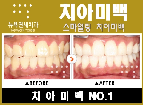  치아필링으로 치아미백 효과를 높인다.