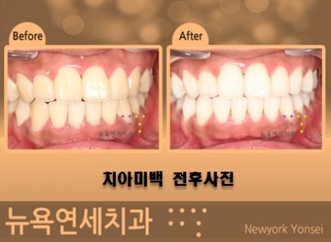  미백치과 * 원데이치아미백 가격과 어떤 미백제를 사용하나요?
