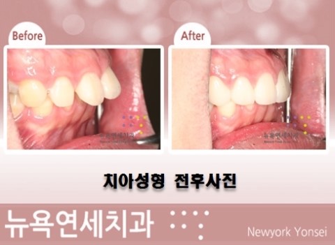  강남역치과이벤트*앞니성형도 하고 친구에게 원데이치아미백을 선물하자!
