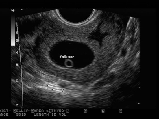 임신 주수 계산법 및 임신 초기 초음파 : 네이버 블로그