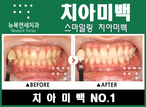  [맞춤형미백] 스탠다드치아미백으로 연예인처럼 치아미백하기!!