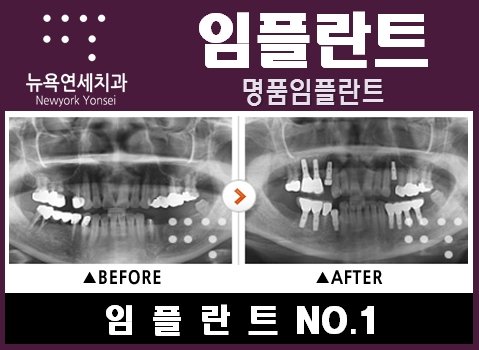  어금니치료 Q&A - 임플란트 브릿지제거후 수술비용