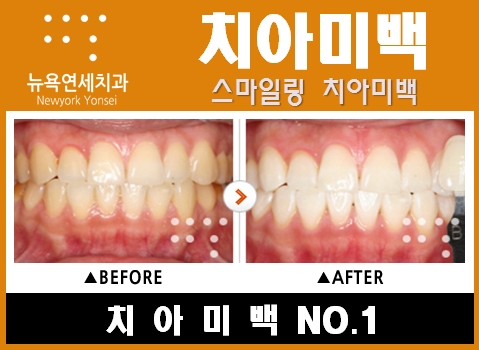  전문가미백 * 스피드치아미백으로 효과를 높이고 빠르게!