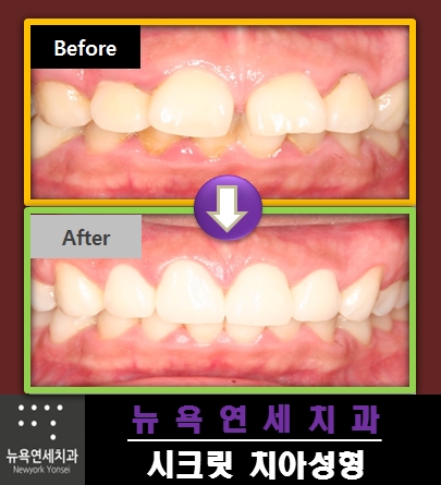  앞니교정가격 * 업그레이드 된 치아성형으로 스타일을 만드는 앞니성형