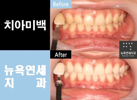  치아미백싼곳? * 전문가미백 효과도 높이고 합리적비용으로 치아미백하기!