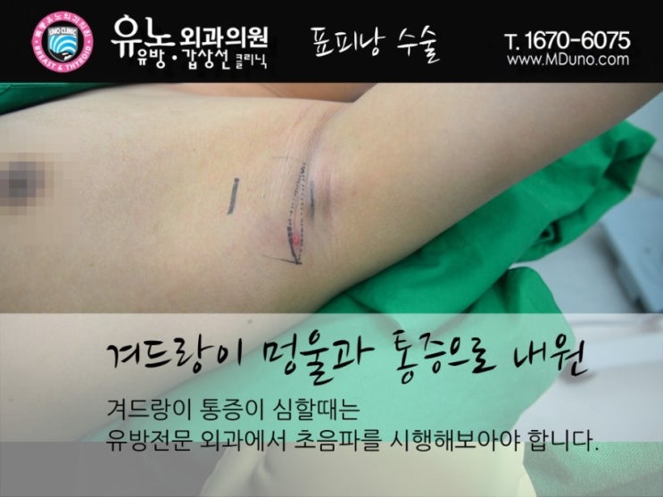 겨드랑이 멍울 통증 아직도 참고 있나요? 3