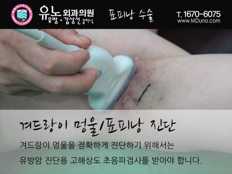 겨드랑이 멍울 통증 아직도 참고 있나요? 5