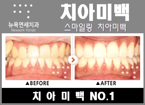  원데이미백이벤트 * 치아미백가격은 저렴하고 효과를 좋은 치아미백이벤트