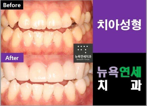  앞니교정 덧니올세라믹으로 빠르게 치아성형