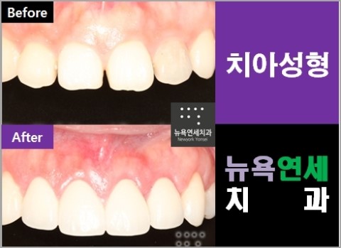  벌어진앞니 라미네이트시술로 앞니교정을 할 수 있습니다