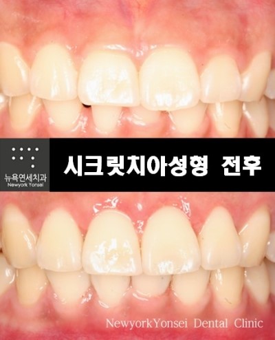  치아성형부작용으로 라미네이트 후회하는 경우가 있다고 합니다.