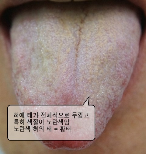 혀의 노란색 피막이 자꾸 들러붙어 혀끝이 아프다.