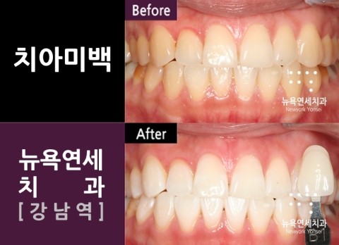  치아미백 이벤트 가격 알아보기!