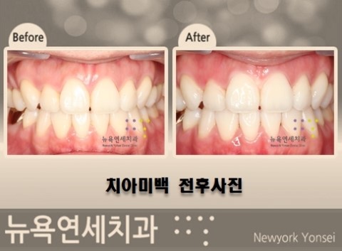  직장인들을 위한 원데이치아미백으로 빠른 전문가미백 하기!