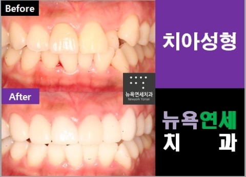  덧니교정 시술 * 덧니라미네이트 vs 덧니올세라믹 어느게 맞을까요?