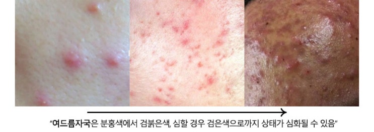 여드름 색소 침착 제거
