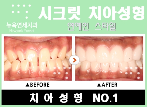  [[연예인라미네이트]] 치아성형으로 연예인처럼 라미네이트하기!!