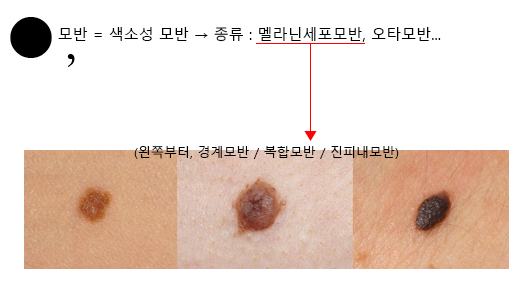 [얼굴점,모반]맞춤 레이저 시술로 흉터/자국없이 깨끗하게 제거해줍니다. 4