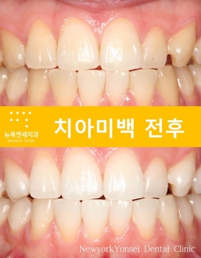  [[연예인미백]] 스마일링 치아미백으로 연예인처럼 하얀치아를 만들어 보세요.
