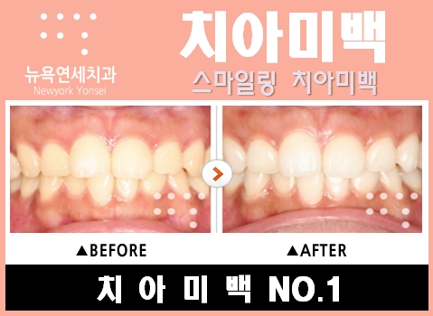  [빠른치아미백]  원데이치아미백으로 하루만에 완성하는 치아미백 전후사진 보기