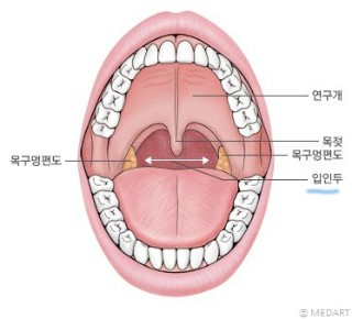 급성 인두염과 만성 인두염의 증상 비교 f. 역류성 인후염 14