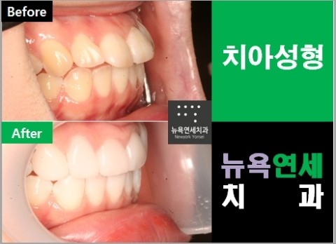  [앞니교정] * 앞니성형으로 돌출 앞니를 교정하는 방법