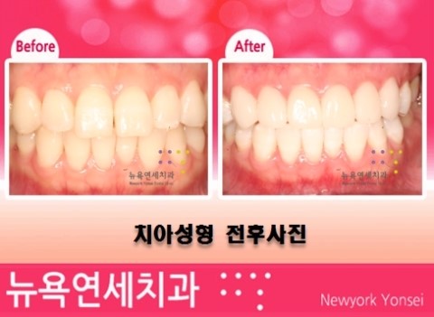 [[큐티스타일 앞니성형]] 여성들이 선호하는 치아성형 스타일 전후사진!