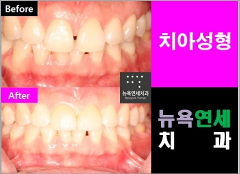  [라미네이트시술 Q&A] 앞니라미네이트에 대한 상담 문의 입니다.