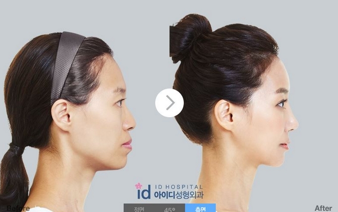 韓国整形情報 出っ歯矯正vs突出し口手術 私はどっち 네이버 블로그 韓国整形情報 出っ歯矯正vs突出し口手術 私はどっち 네이버 블로그