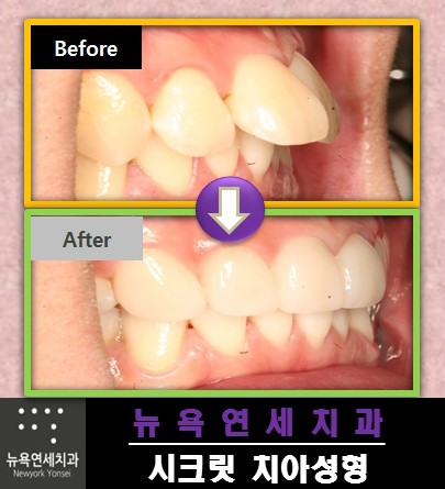 부정교합이나 돌출입도 올세라믹 치아로 교정을 받을 수 있습니다.