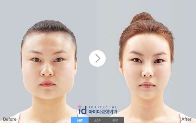 韓国整形情報 小顔術 頬骨 エラ削り ってご存じですか 네이버 블로그