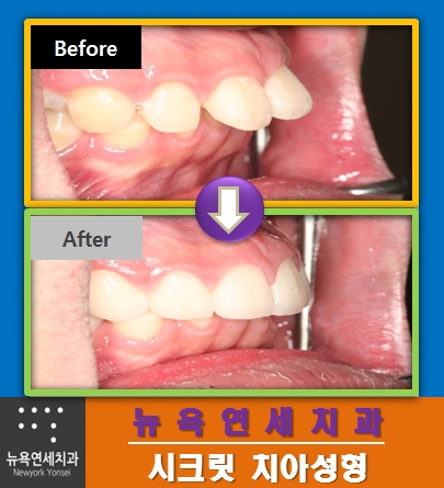 [부정교합 치아교정] * 올세라믹 치아성형으로 과개교합을 교정한다.