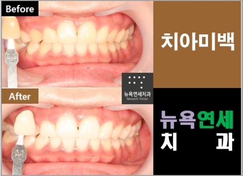 [치과미백]  원데이치아미백(전문가미백)으로 하루만에 치아미백을 완성할 수 있다.