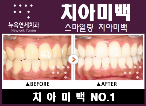  뉴욕연세치과 치아미백 가격은 얼마? [원데이미백 이벤트]