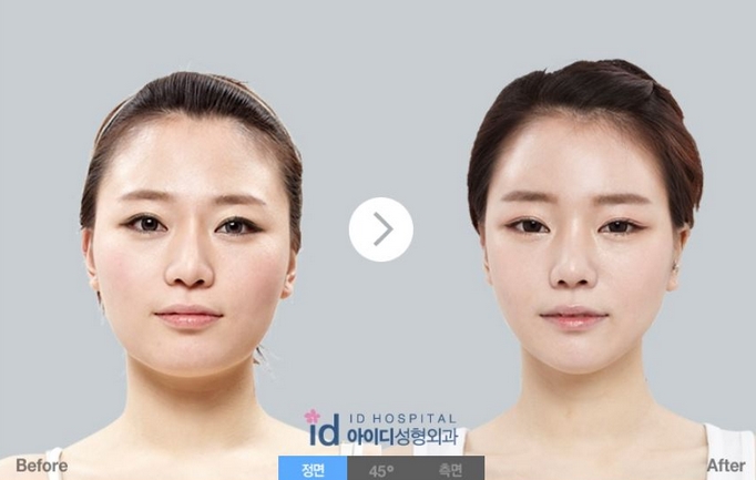 韓国整形情報 より小さく より若く 童顔術とは 네이버 블로그