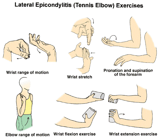 Tennis Elbow "Lateral Epicondylitis" (테니스 엘보우, 외측 상과염) : 네이버 블로그