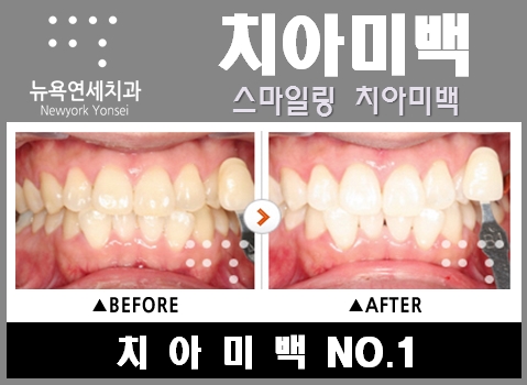 [미백전후] 치아미백 방법으로 알아보는 치아미백 효과