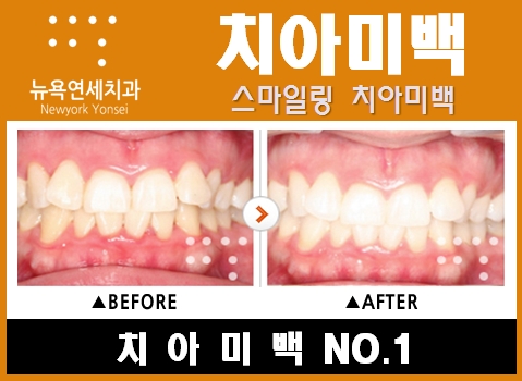  [원데이 치아미백가격] - 치아미백 유명한곳에서 원데이 치아미백가격은?