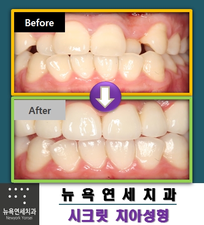  앞니치아성형 * 앞니라미네트로 알아보는 앞니교정 기간?