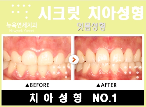  [잇몸성형가격 ] * 스마일라인 잇몸성형수술 비용 알아보기