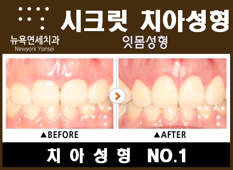  잇몸교정방법 * 불규칙한 잇몸은 잇몸성형으로 잇몸을 교정 할 수 있다.