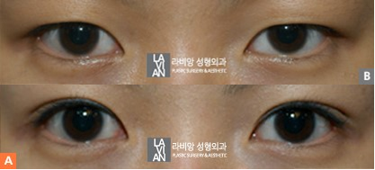 눈사이가멀어요 눈 가로길이 길어지는법 : 네이버 블로그 눈사이가멀어요 눈 가로길이 길어지는법 : 네이버 블로그