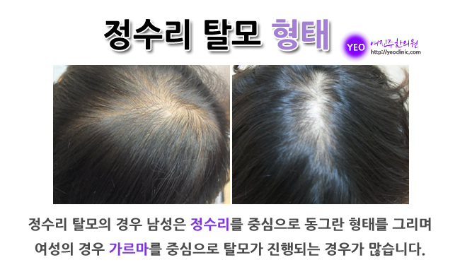 의정부탈모 범위와 개수가 각각 6