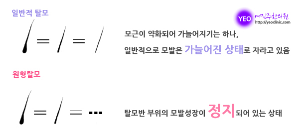 의정부탈모 범위와 개수가 각각 3