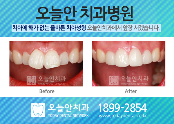 앞니 라미네이트 / 연예인 치아성형 4