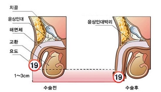길이연장술 약물 없이 극복할수 있다고 5