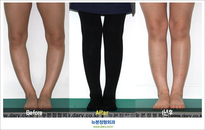 오다리수술 후 정말 키가 커질 수 4