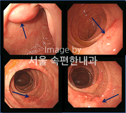 십이지장성 십이지장종 형태 표지