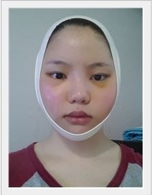 韓国整形 輪郭整形 頬骨削り の体験談です 네이버 블로그
