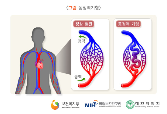뇌 동맥류와 뇌 동정맥 기형의 차이점은 무엇이며 어떻게 치료합니까? 뇌 동맥류와 뇌 동정맥 기형의 차이점은 무엇이며 어떻게 치료합니까?